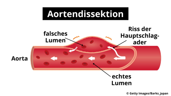 © Getty Images/Barks_japan | © Aortendissektion: Riss in der Aorta