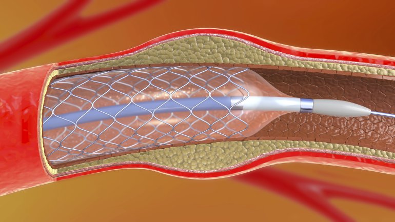 Ein Stent hält ein verschlossenes Gefäß offen und schützt vor einem Herzinfarkt.